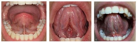 Tongue Tie Functional Release