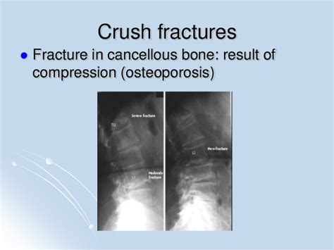 Fractures, bone healing & principles of tx. of fractures