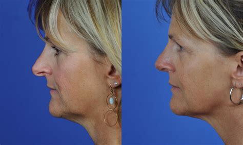 A faculty of perceiving or detecting:to have a nose for news. Droopy Nasal Tip Correction