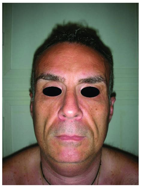 Preoperative Frontal View Of A Patient Presenting Facial Wasting And