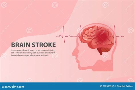 Stroke Types Poster Banner Vector Medical Illustration White