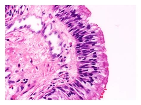 Trachea histology slide) click to enlarge. (a) Cystic lesion lined by pseudostratified ciliated ...