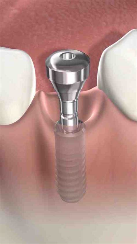 What Does A Titanium Dental Implant Screw Look Like Dental News Network