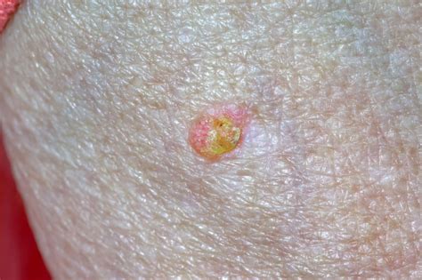 Actinic Keratosis Pictures Symptoms And Causes Today
