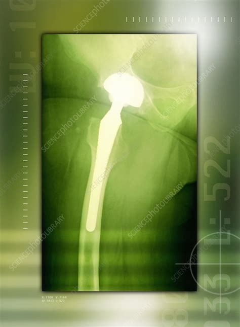 Hip Replacement X Ray Stock Image M6000283 Science Photo Library