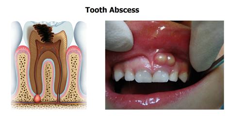 What Is Phoenix Dental Abscess News Dentagama