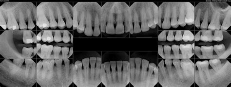 13 Bone Loss In Teeth X Ray Clodaghebony