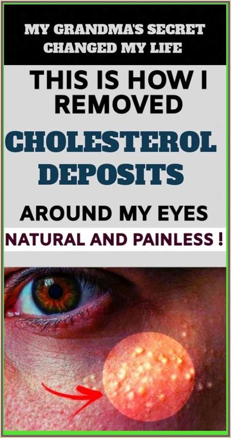 7 Remedies To Get Rid Of Cholesterol Milk Spots Naturally Cholesterol