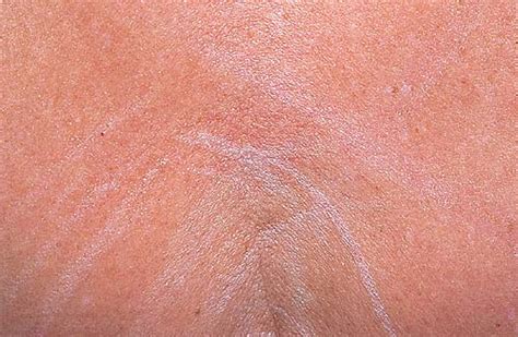 Medical Pictures Info Dry Skin
