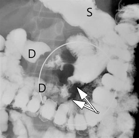 Small Bowel Neoplasms A Pictorial Review Radiographics