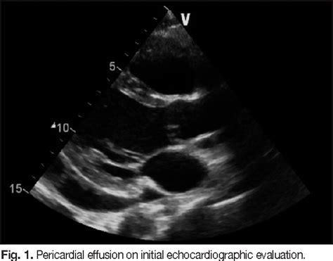 Figure 1 From Primary Malignant Pericardial Mesothelioma Presenting As