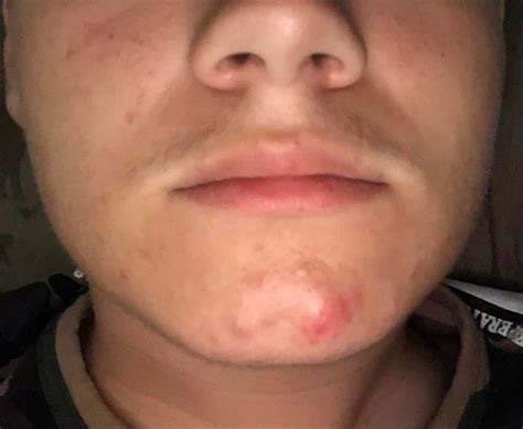 What Is The Red Lump On My Chin Is It A Boil I Leaves And Then Comes