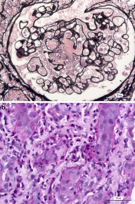 Renal Involvement In Eosinophilic Granulomatosis With Polyangiitis