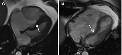 Severe Left Ventricular Outflow Tract Obstruction Immediately After