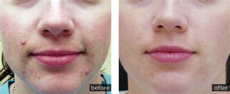 Laser Acne Scar Removal Treatment Nyc Dermatology And