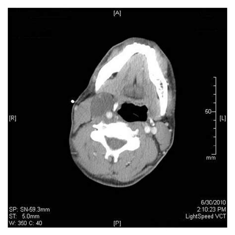 Coronal View Of A Ct Scan With Contrast Showing Right Cystic Neck Mass