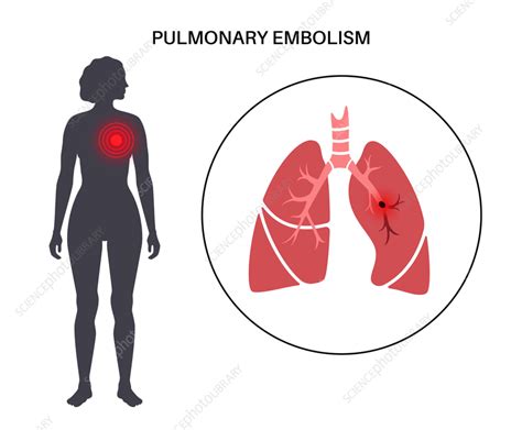 Pulmonary Embolism Illustration Stock Image F0366472 Science