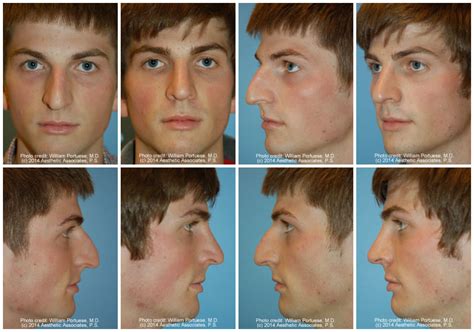 Crooked Nasal Bones Before And After Photo Gallery Nose Surgery Photos