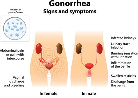 Listen to your partner and offer support. Gonorrhea in Pregnancy :: American Pregnancy Association