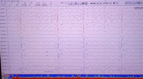 Electroencephalography Eeg Of A Sspe Patient Depicts The Periodic