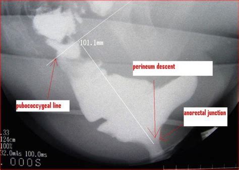 Descending Perineum Syndrome Eurorad