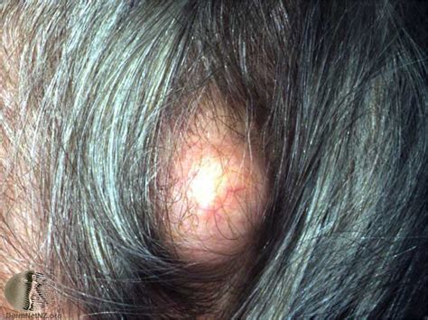 Pilar Cyst On The Scalp Pictures Symptoms Removal Video Ehealthstar