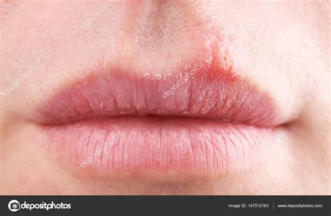 Herpes Blisters On Female Lips — Stock Photo © Belchonock 147512163