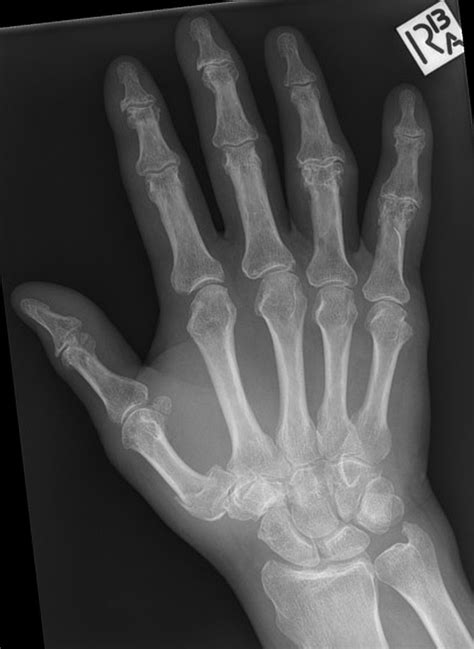 Base Of Thumb Fractures Hand Orthobullets