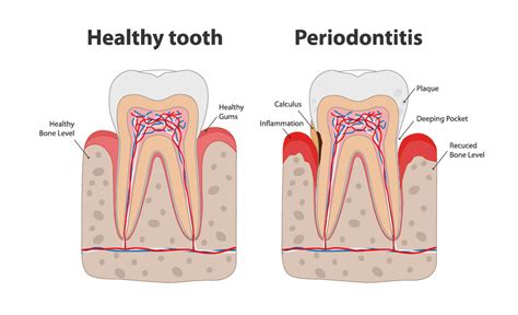 Removal Of Gum And Bone Infections Dr Shervin Molayem Periodontist