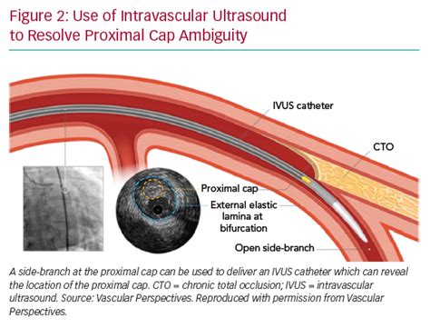 Use Of Intravascular Ultrasound To Resolve Proximal Cap Ambiguity