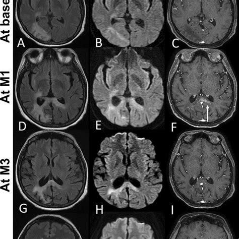Baseline And Follow Up Brain Mris Of The Patient 2 T2 Flair A C F