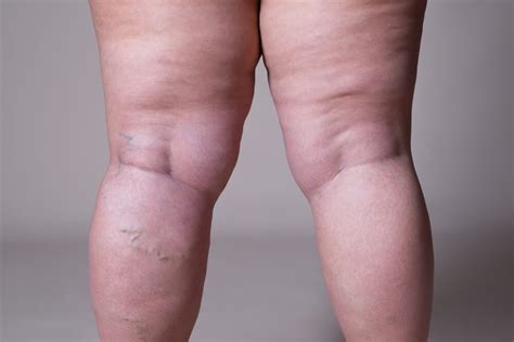 Risk Factors For Varicose Veins Advanced Surgical Physicians