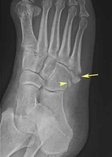 Avulsion Of The Fifth Proximal Metatarsal X Ray Of Foot Radrounds Radiology Network