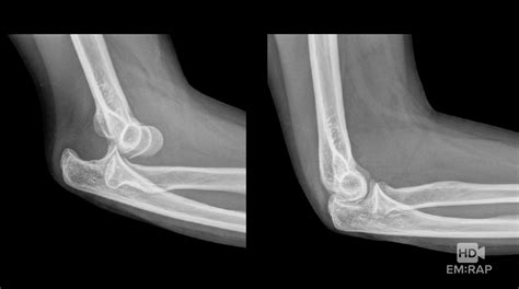 Hd Reduction Of Elbow Dislocation Emrap