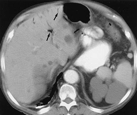 Portomesenteric Vein Gas Pathologic Mechanisms Ct Findings And