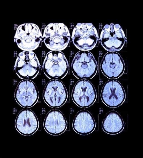 Neuroimaging What Is It And How Can It Map The Brain