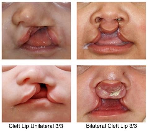 Cleft Lip And Cleft Palate Dell Childrens Craniofacial Team Of Texas