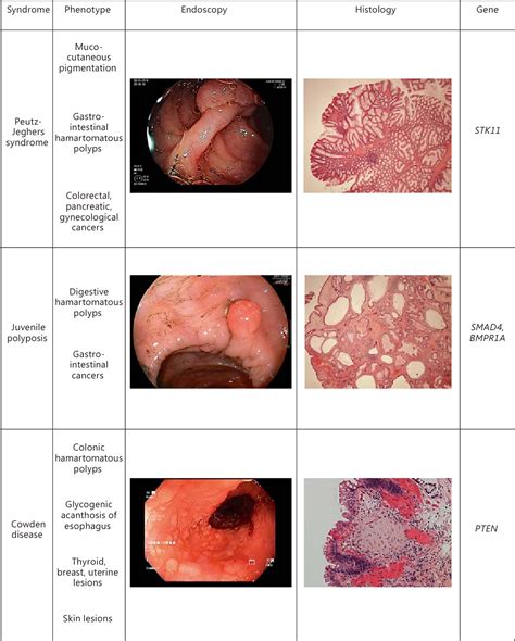 hamartomatous tumors in the gastrointestinal tract semantic scholar