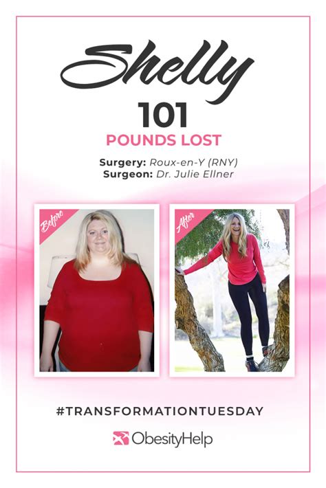 Before And After Rny With Shelly Down 101 Pounds Obesityhelp
