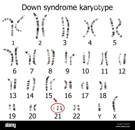 Down Syndrome Karyotype Stock Photo Alamy