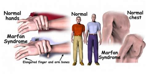 Marfan Syndrome Diagnosis And Treatment In Thailand Almurshidi Medical Tourism Best
