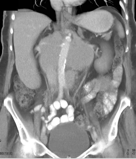 Lymphoma With Extensive Para Aortic Adenopathy And Mesenteric Mass