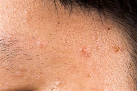 Difference Between A Blackhead And Whitehead Pimple Livestrongcom