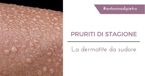 Dermatite Periorale Cause E Rimedi Prof Antonino Di Pietro My Xxx Hot