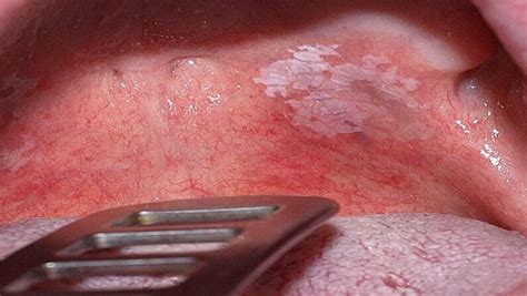 White Spots On Throat Causes And Treatments Kingwood Er