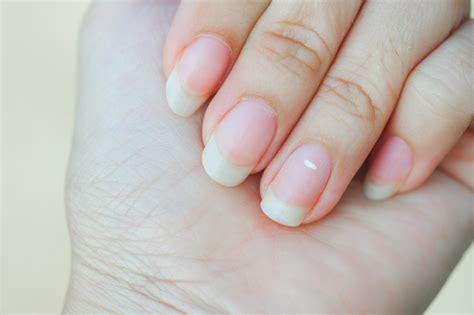 White Spots On Nails How To Treat Them Healthy Nails