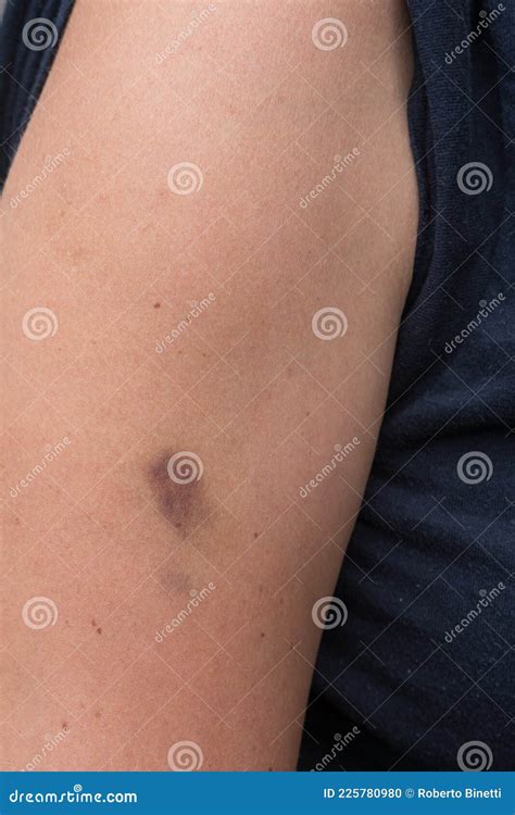 Bruise On Woman Arm Closeup Stock Photo Image Of Accident Injured