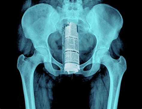 Shocking X Rays Reveal The Strange Items Irish People Use During Sex