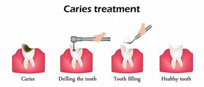 Tooth Decay Dental Caries Fillings Treatment Procedure