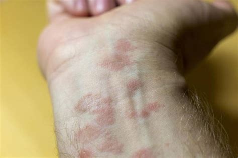 What Is Eczema Its Dermatitis